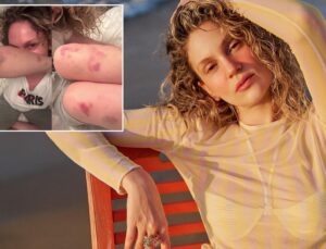 Farah Zeynep Abdullah’ın vücudundaki morluklar korkuttu