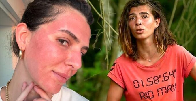 Survivor Merve Aydın’ın değişimi şaşırttı! Yüzüne yaptırdığı işlemi tek tek anlattı