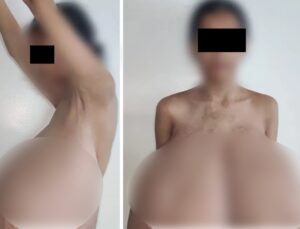 13 yaşında başladı! Göğüsleri vücut ağırlığının dörtte birine ulaştı