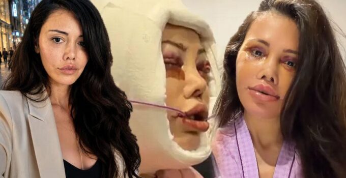 Didem Ceran 15 saatlik operasyonla yüz nakli olmuştu! Kendisini dünyaca ünlü yıldızla karşılaştırdı