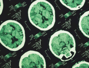 Alzheimer’ın izleri unutkanlıktan yıllar önce başlayabiliyor
